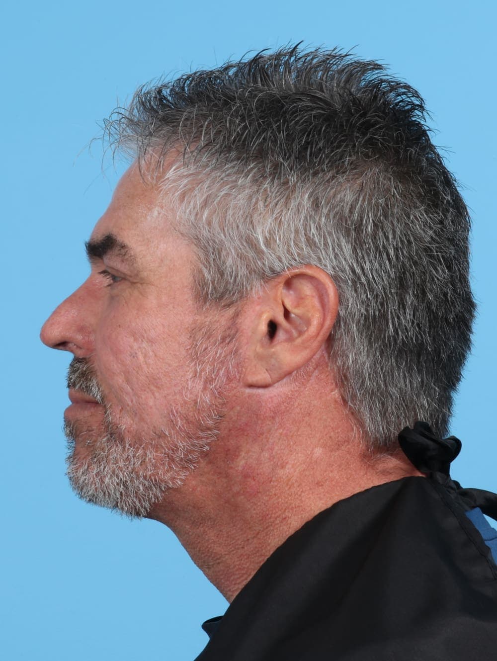 Facelift case #3518 after, image 3