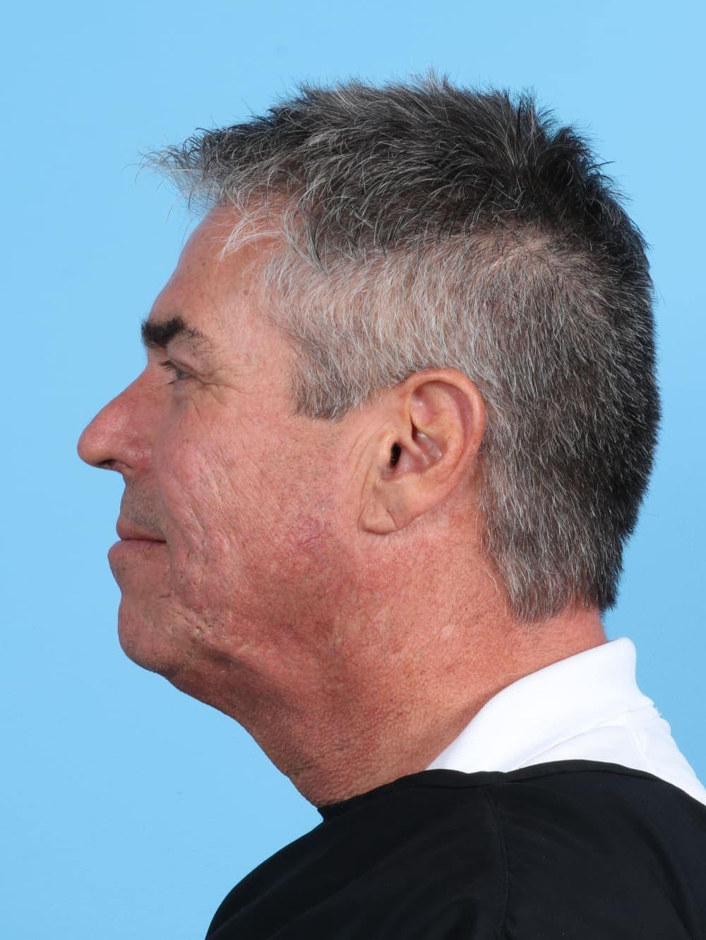 Facelift case #3518 before, image 3