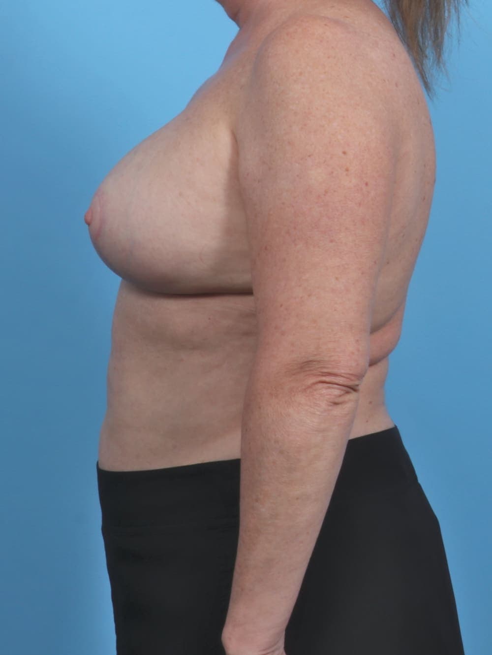 Breast Implant Revision case #4507 after, image 3