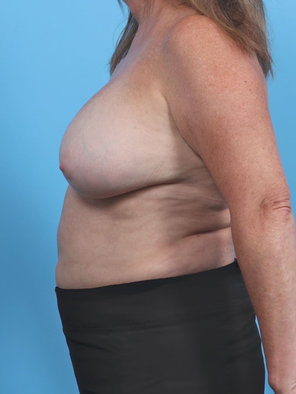 Breast Implant Revision case #4507 before, image 3