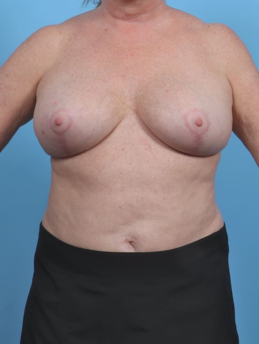 Breast Implant Revision case #4507 after, image 1