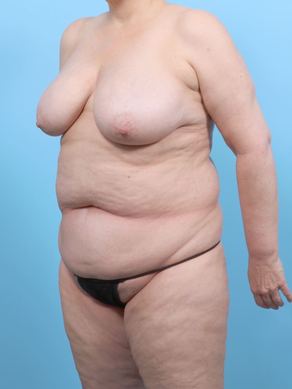 Mommy Makeover case #6497 before, image 3