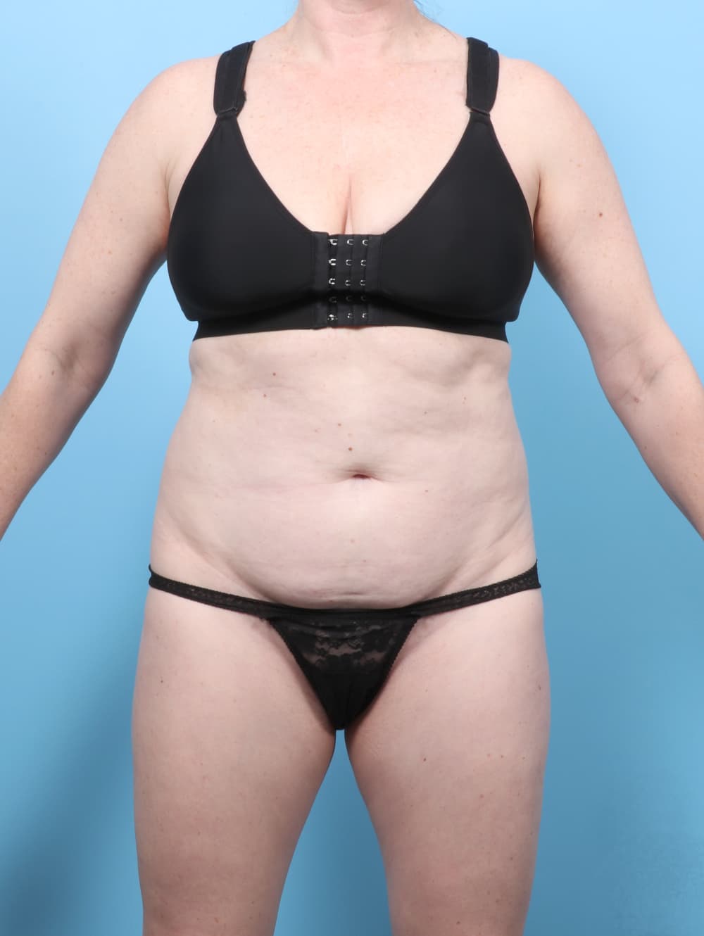 Tummy Tuck case #8674 before
