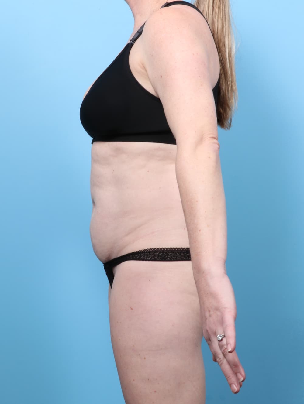 Tummy Tuck case #8674 before, image 3