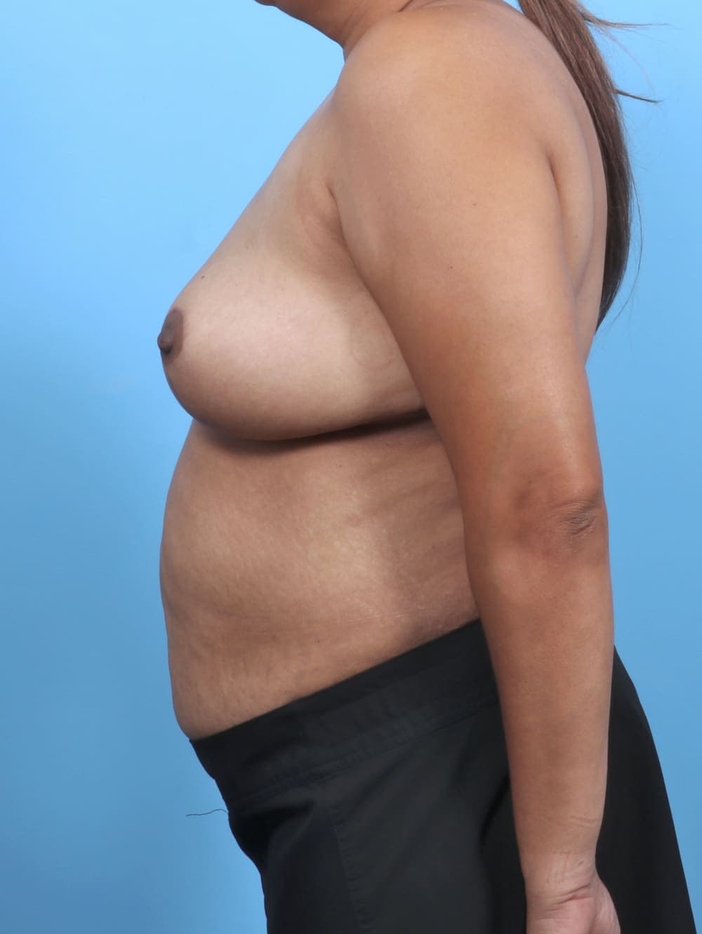 Breast Lift/Reduction case #5660 after, image 3