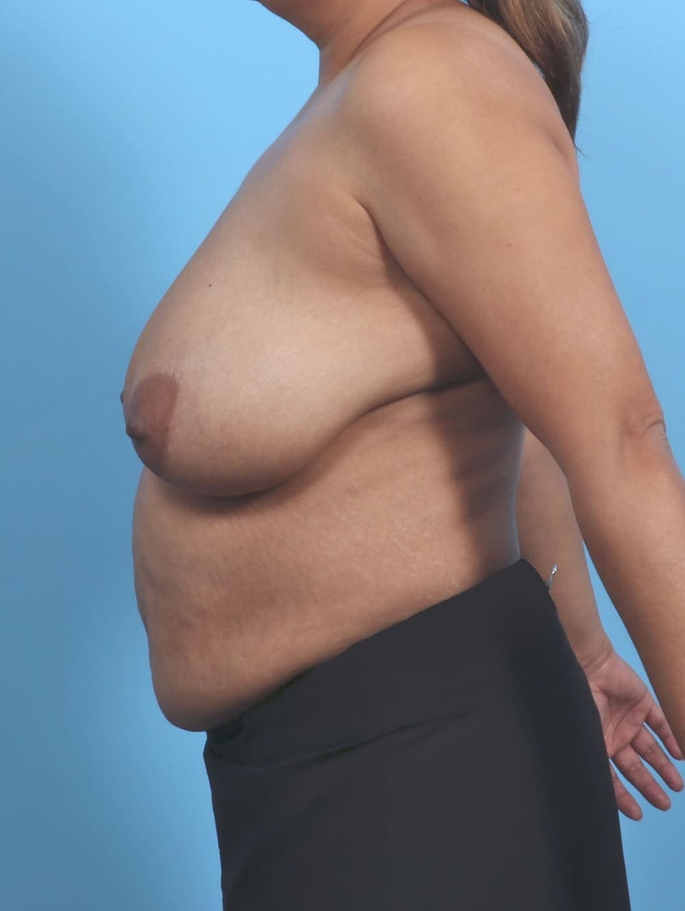 Breast Lift/Reduction case #5660 before, image 3