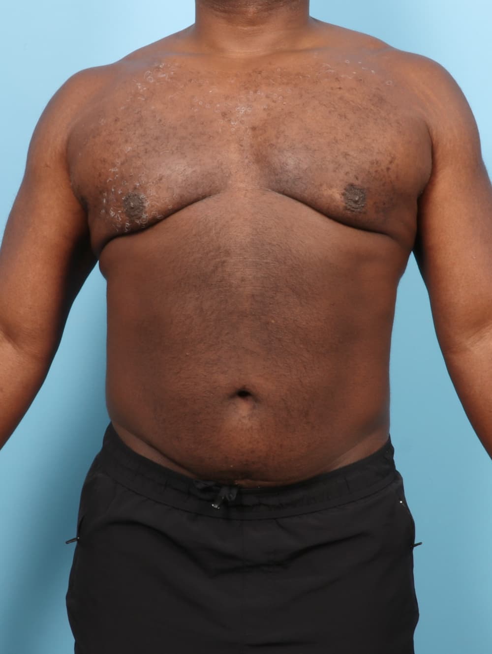Male Breast Reduction case #7543 after, image 1