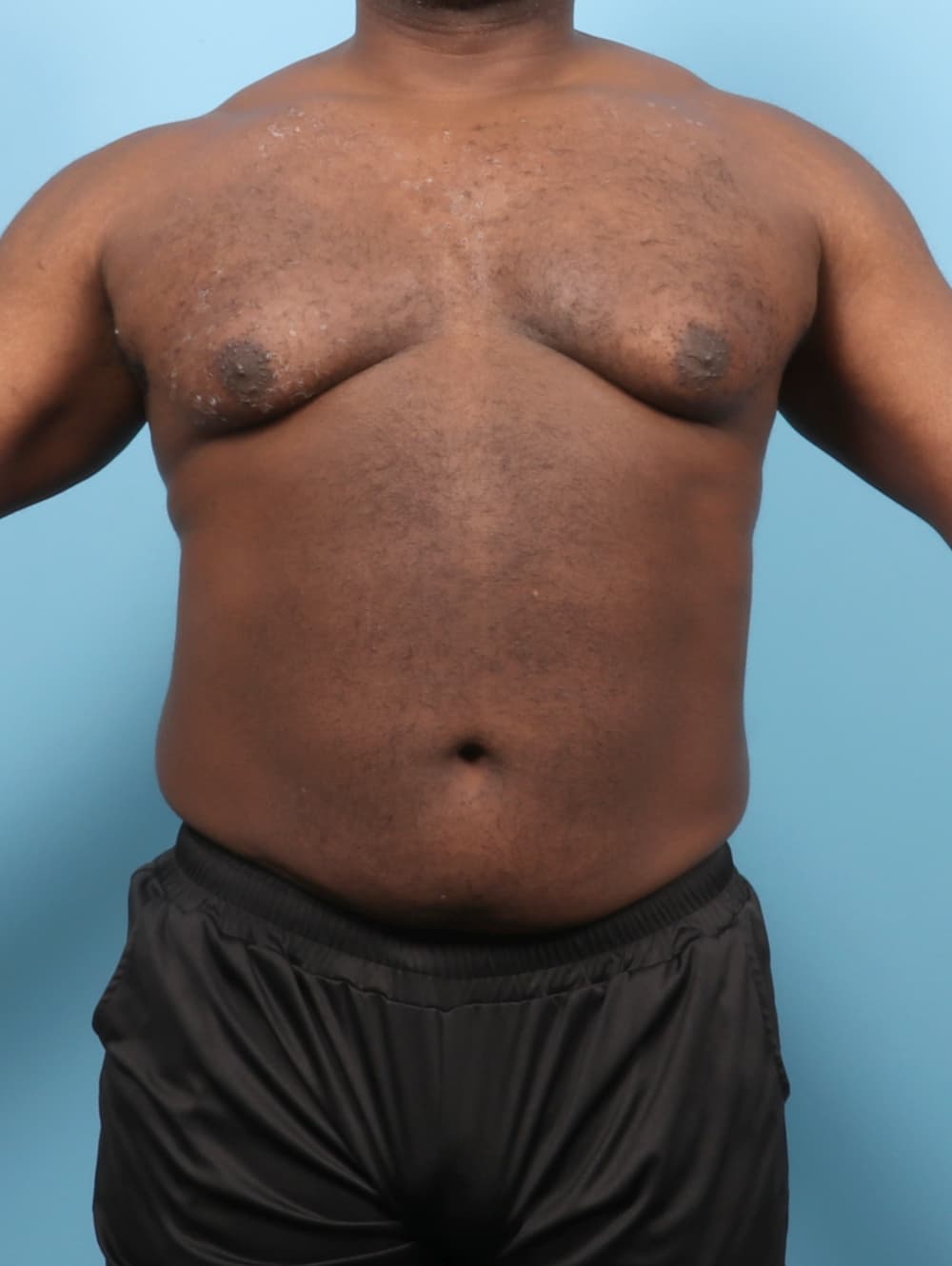 Male Breast Reduction case #7543 before, image 1