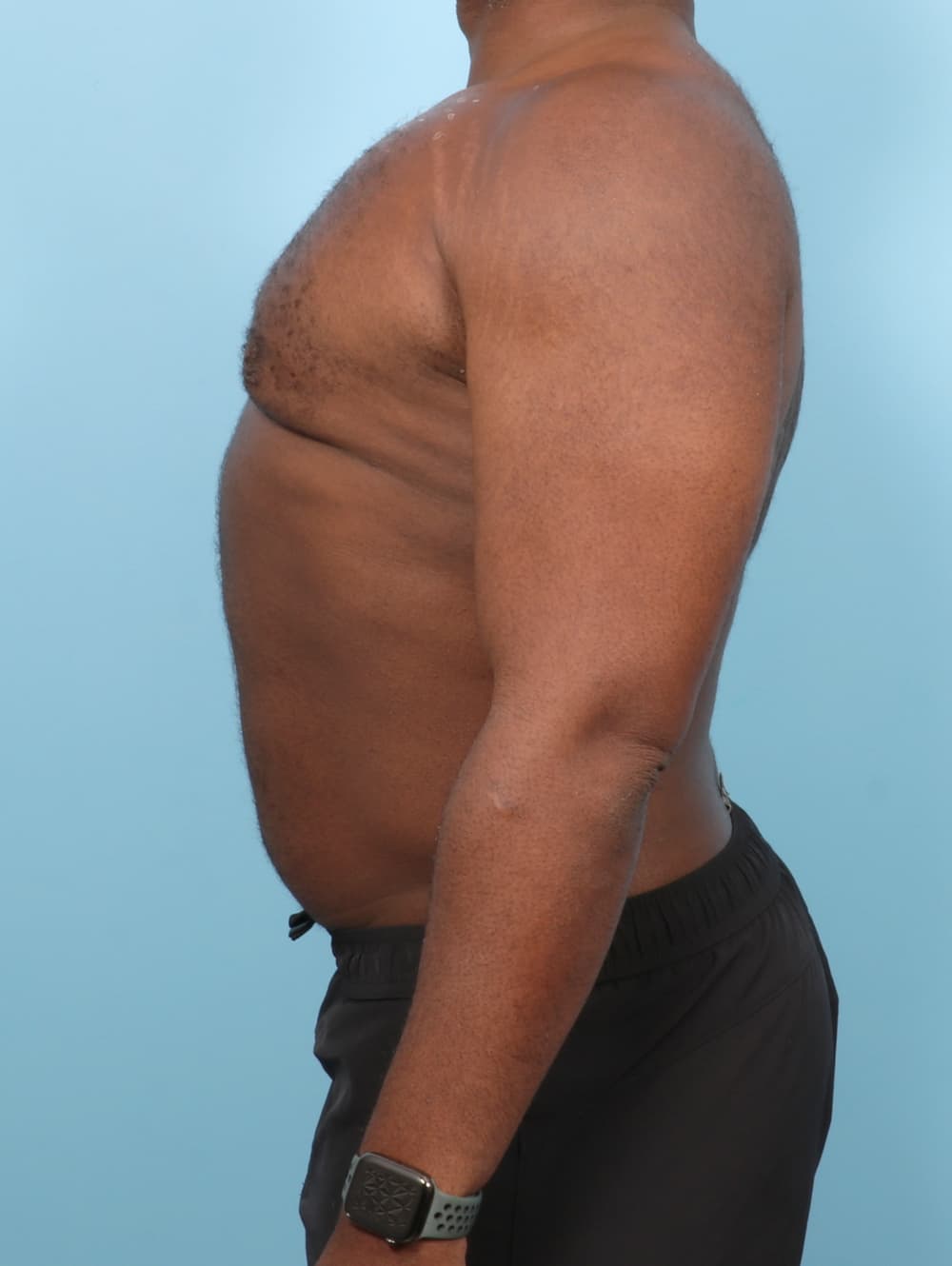 Male Breast Reduction case #7543 after, image 3