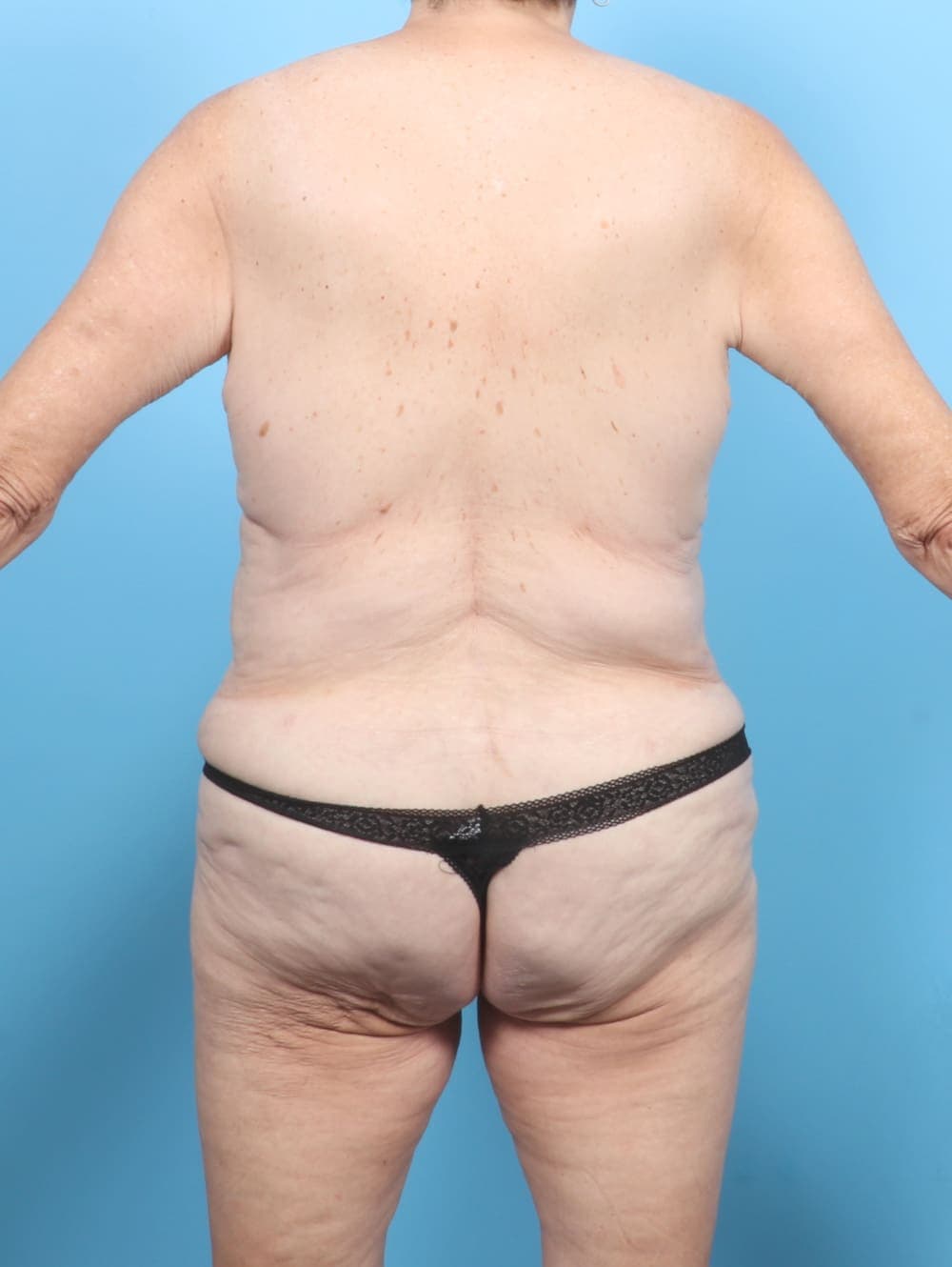 Tummy Tuck case #6885 after, image 4