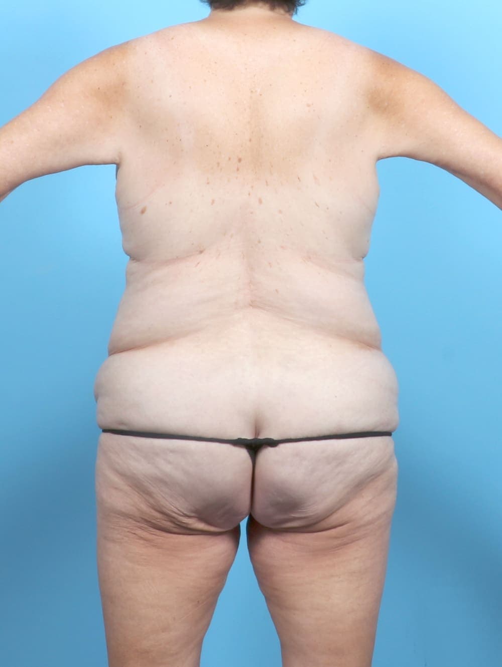 Tummy Tuck case #6885 before, image 4