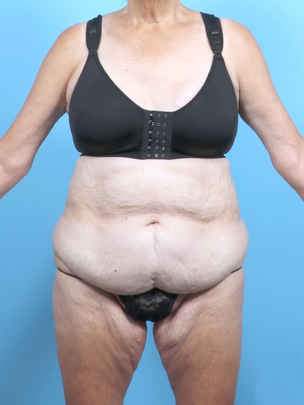 Tummy Tuck case #6885 before, image 1
