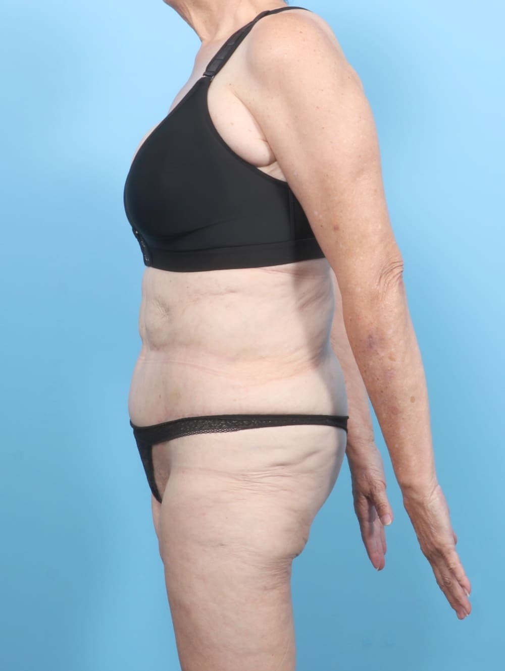 Tummy Tuck case #6885 after, image 3