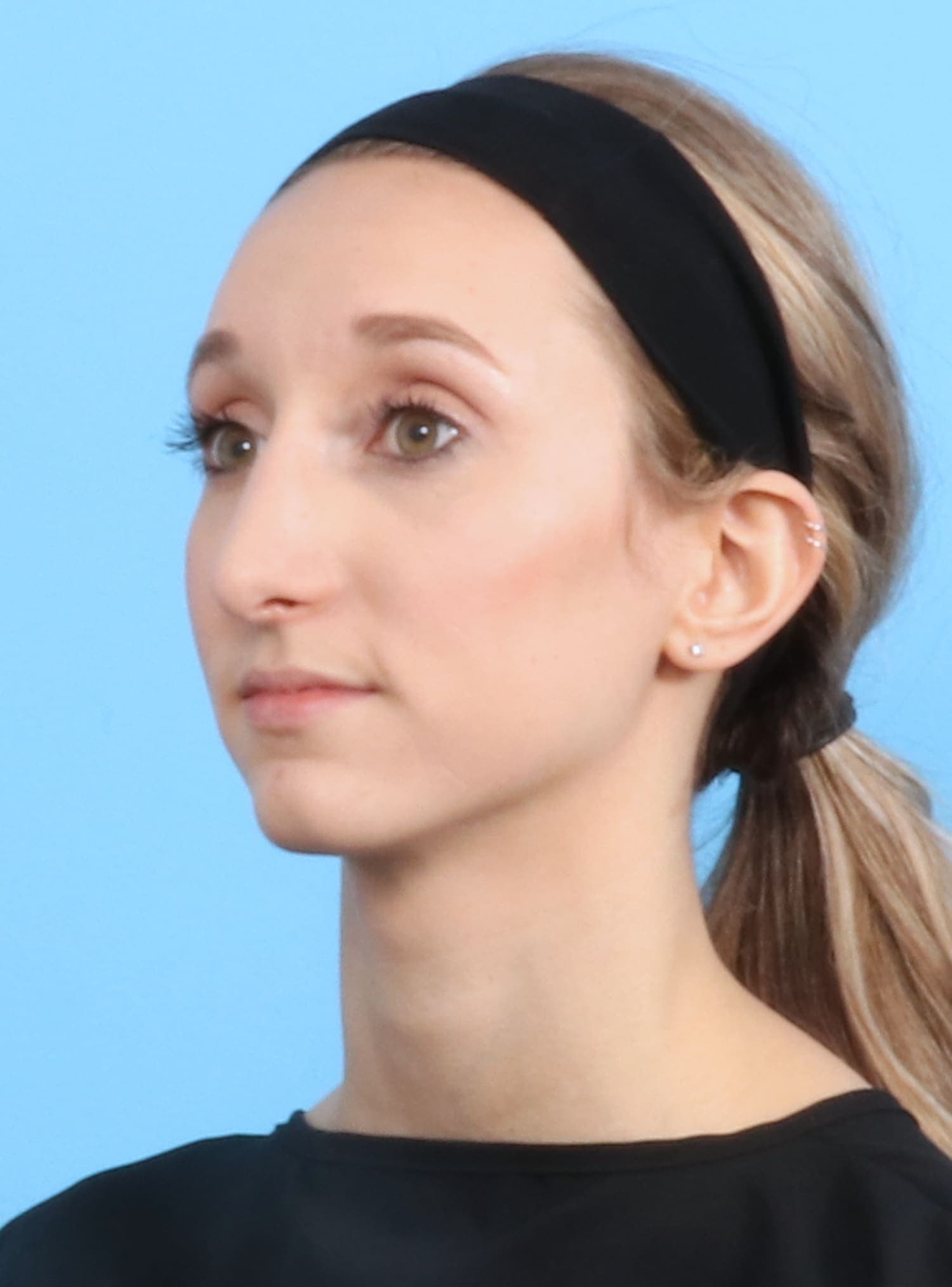 Rhinoplasty case #1321 after, image 3