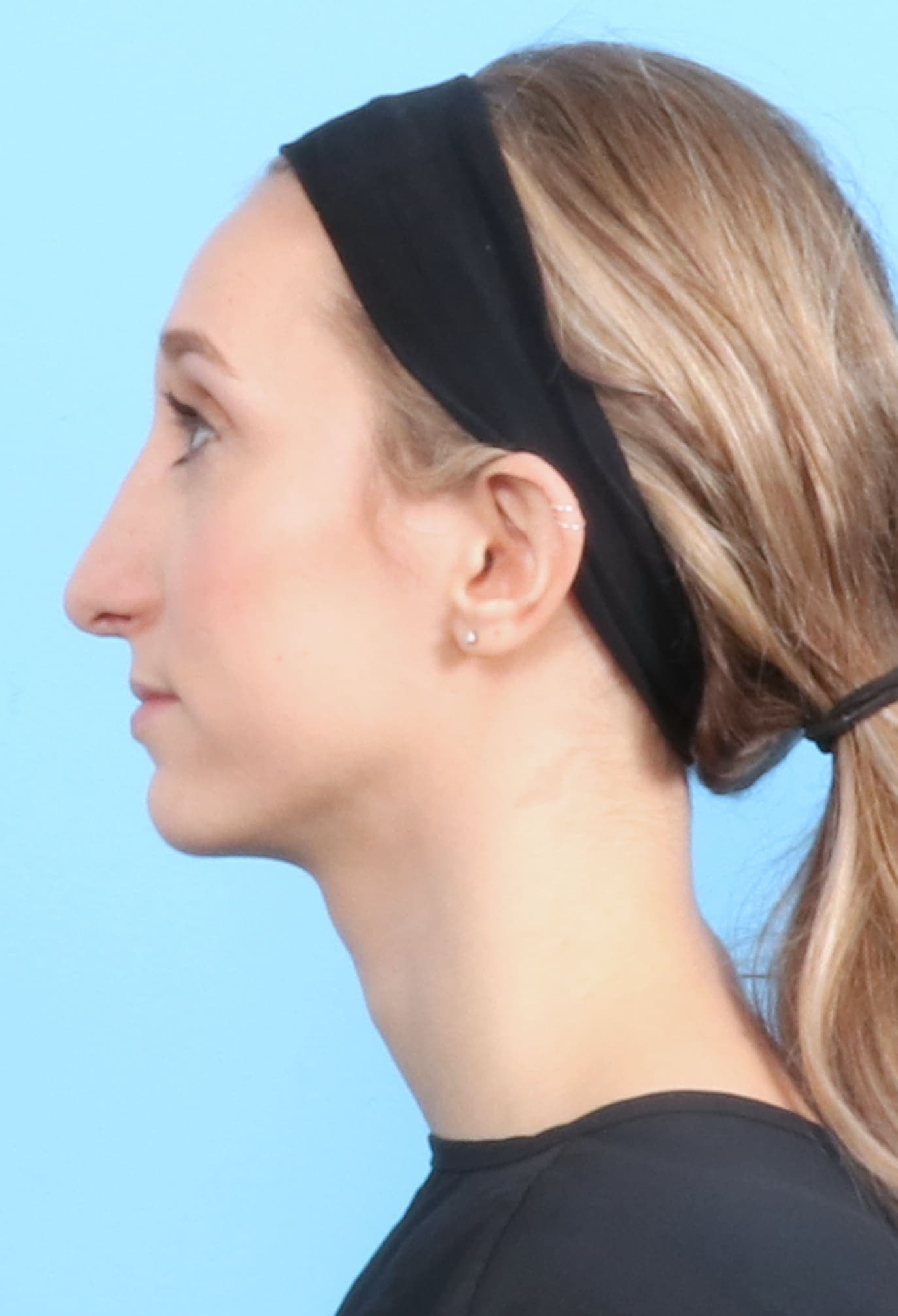 Rhinoplasty case #1321 after, image 1