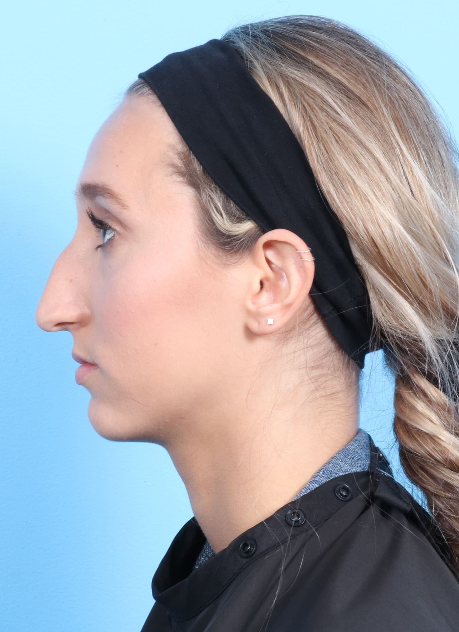 Rhinoplasty case #1321 before, image 1