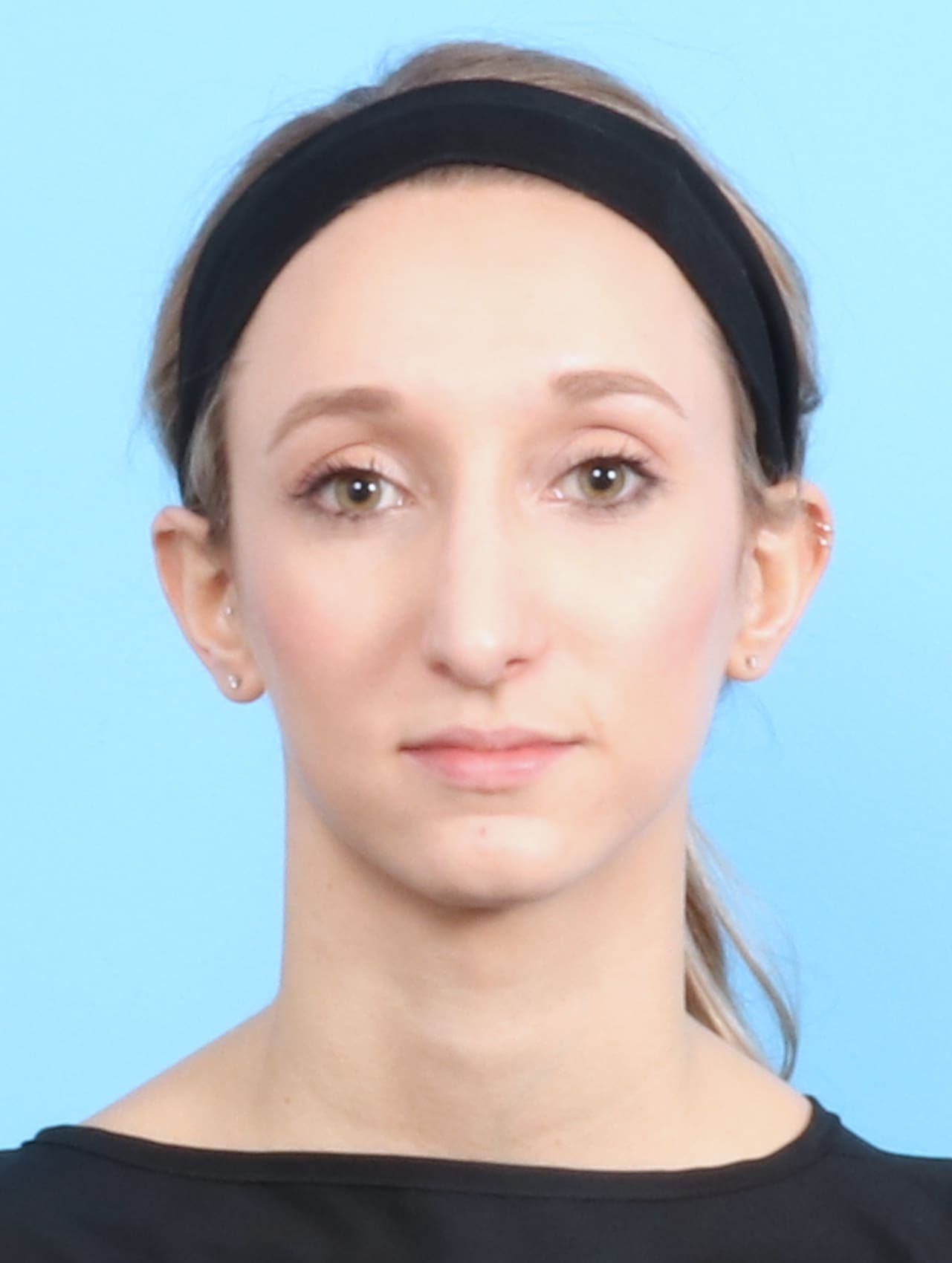 Rhinoplasty case #1321 after, image 2