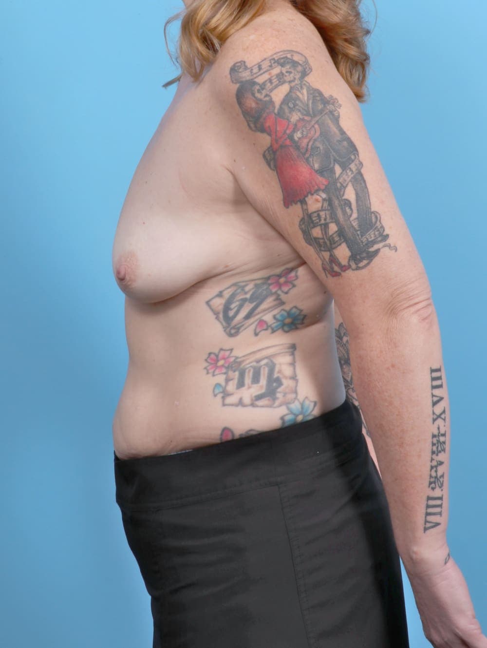Breast Lift with Implants case #6359 before, image 3