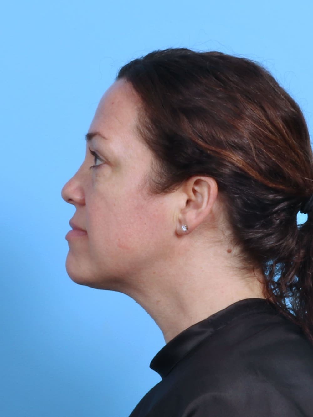 Eyelid Surgery case #4387 before, image 3