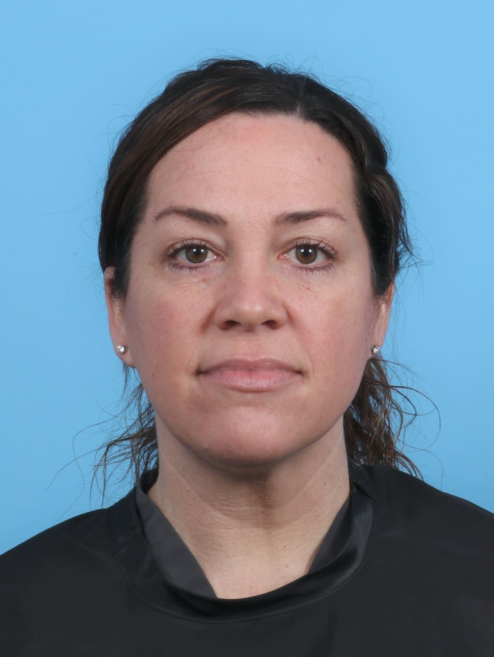 Eyelid Surgery case #4387 after, image 1