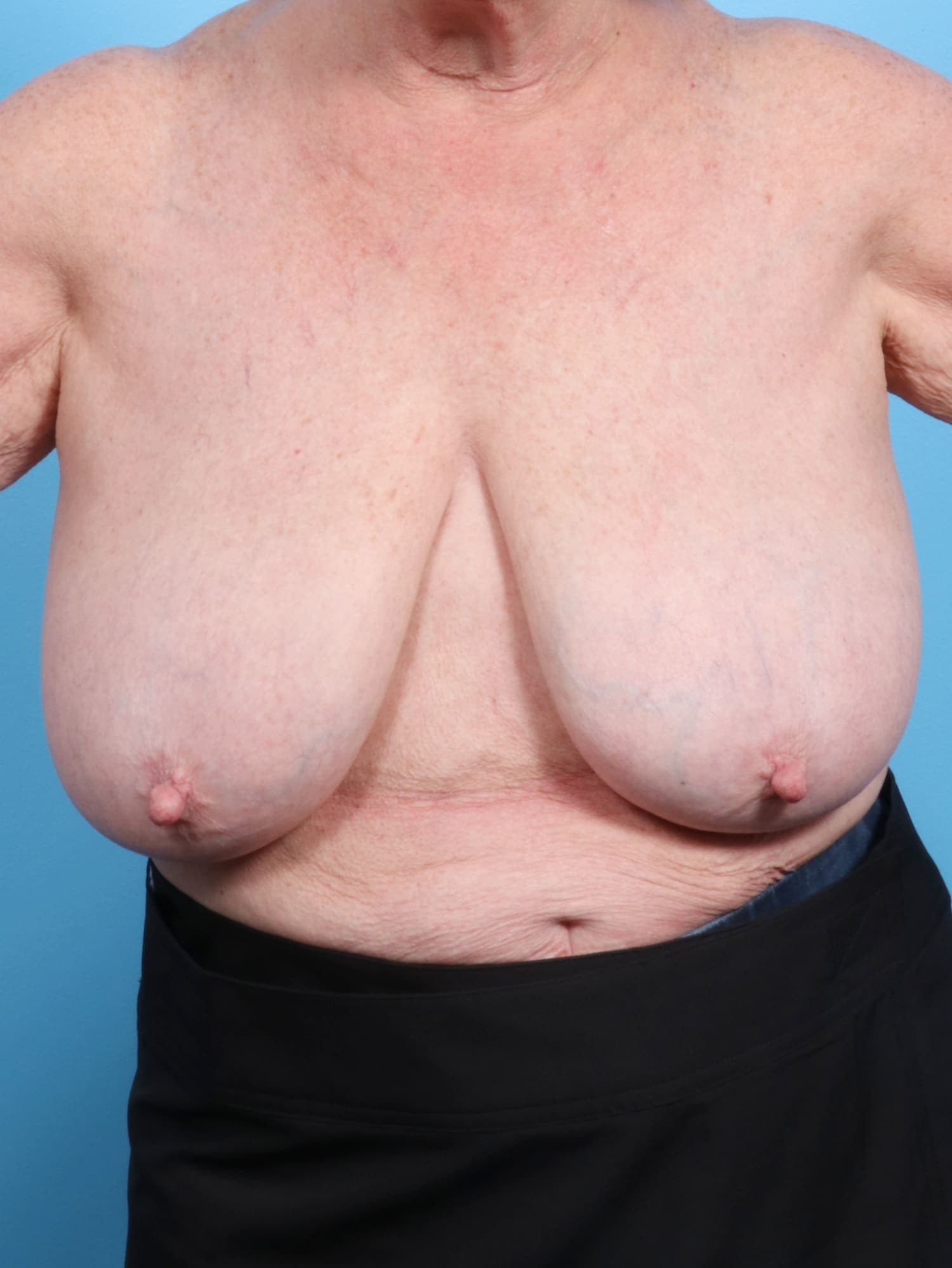 Breast Lift/Reduction case #1305 before, image 1