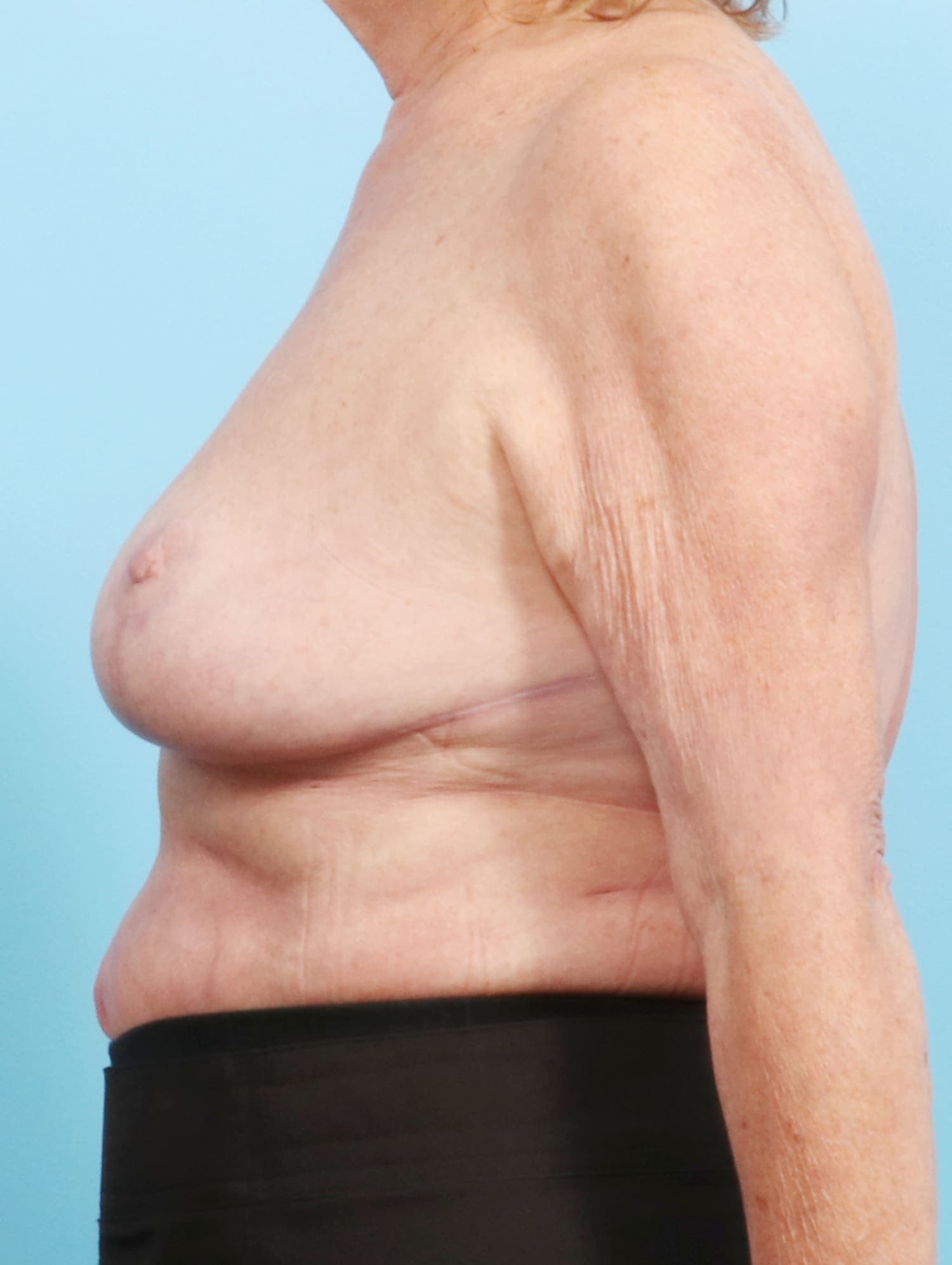 Breast Lift/Reduction case #1305 after, image 3