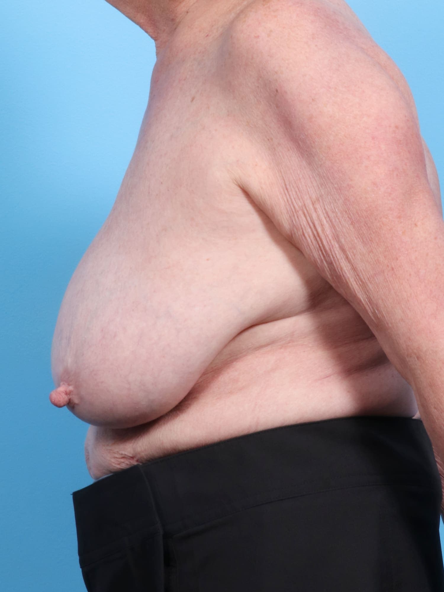 Breast Lift/Reduction case #1305 before, image 3