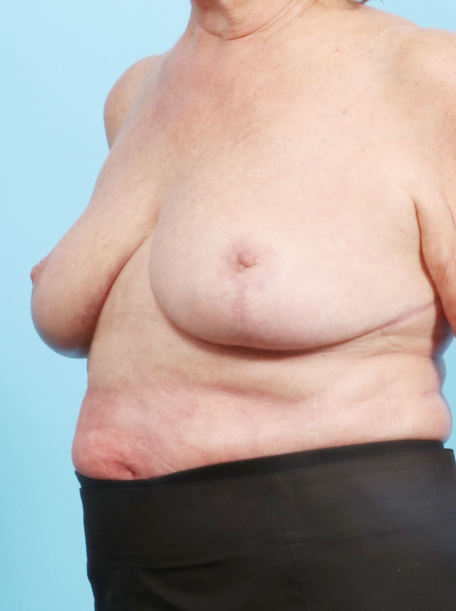 Breast Lift/Reduction case #1305 after, image 2