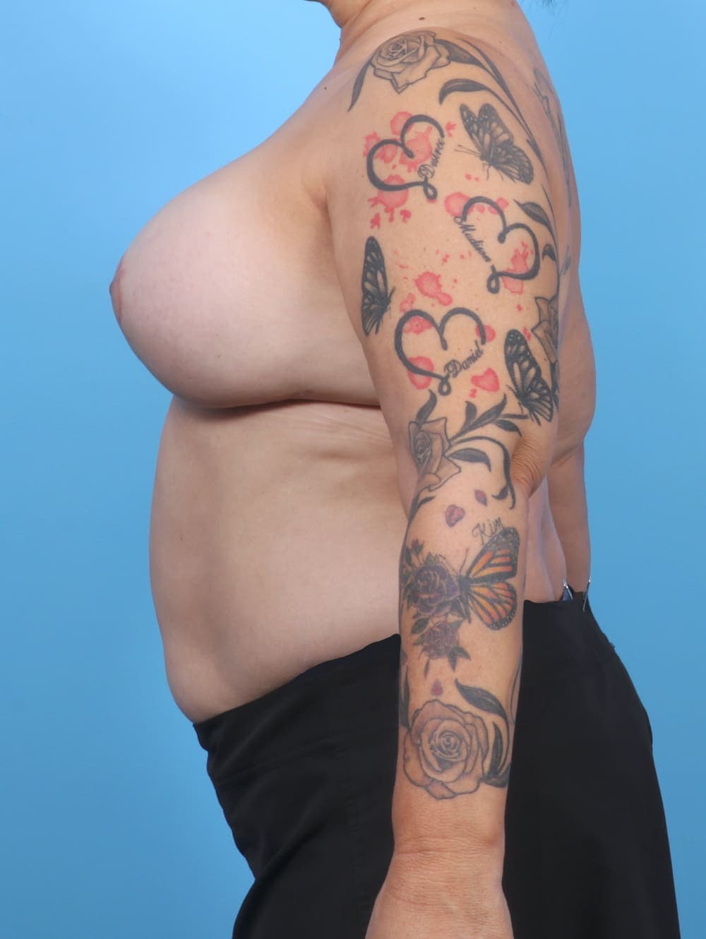 Breast Implant Revision case #5984 after, image 3