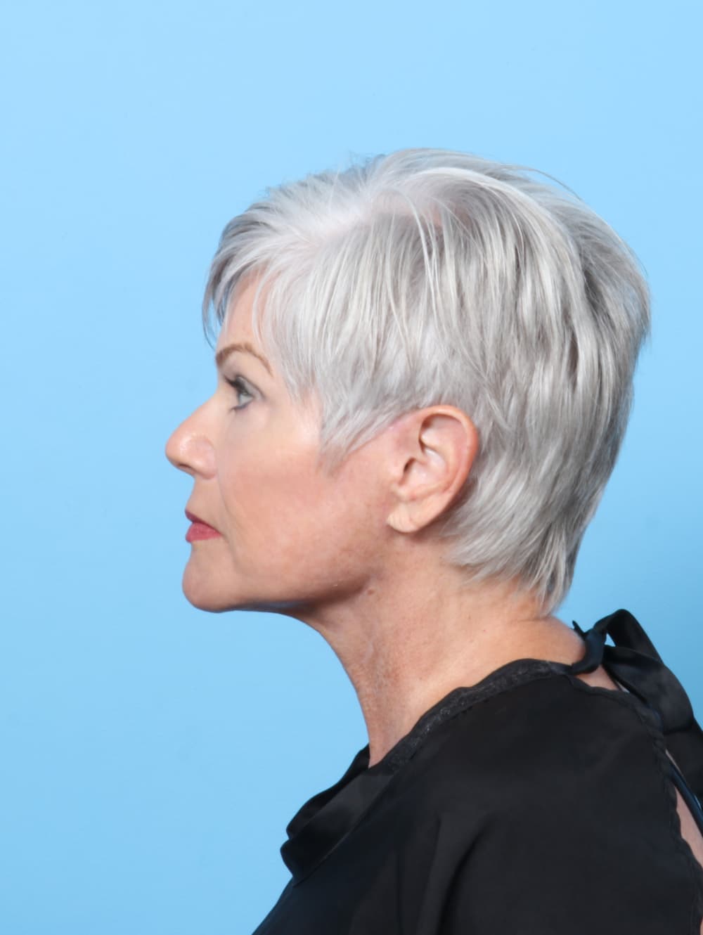 Facelift case #8306 after, image 3