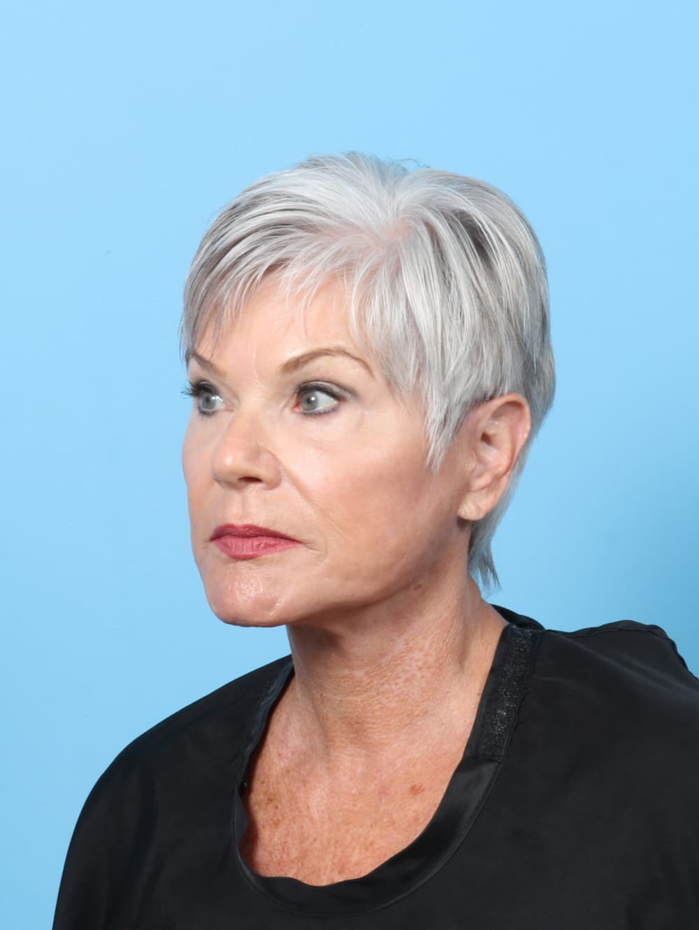 Facelift case #8306 after, image 4