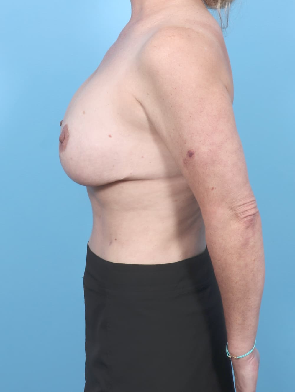 Breast Implant Removal with Lift case #7154 before, image 3