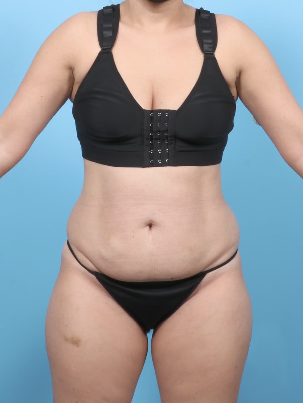 Tummy Tuck case #8255 before