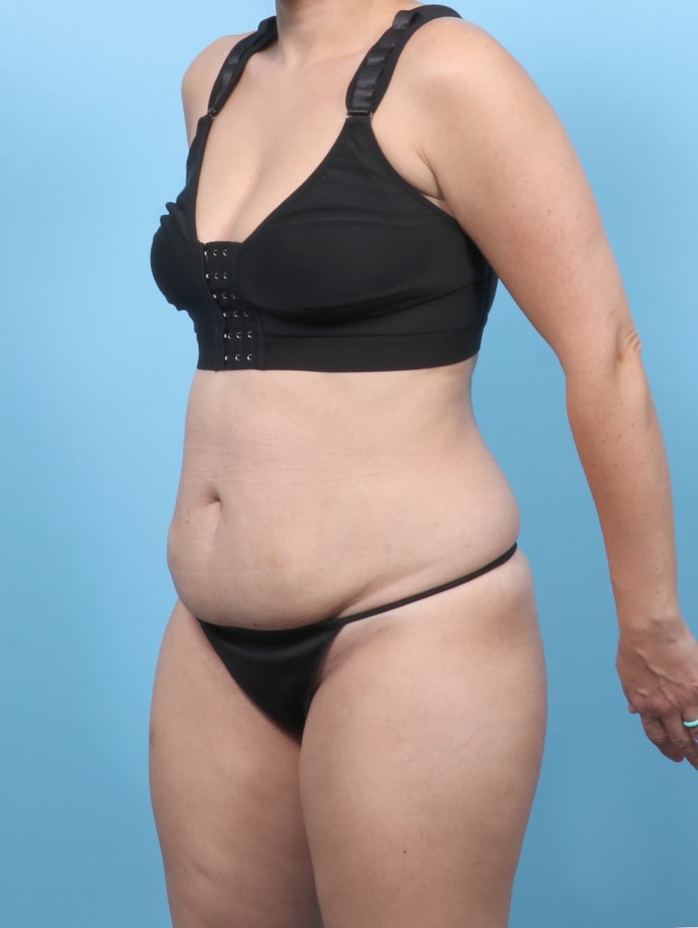 Tummy Tuck case #8255 before, image 2