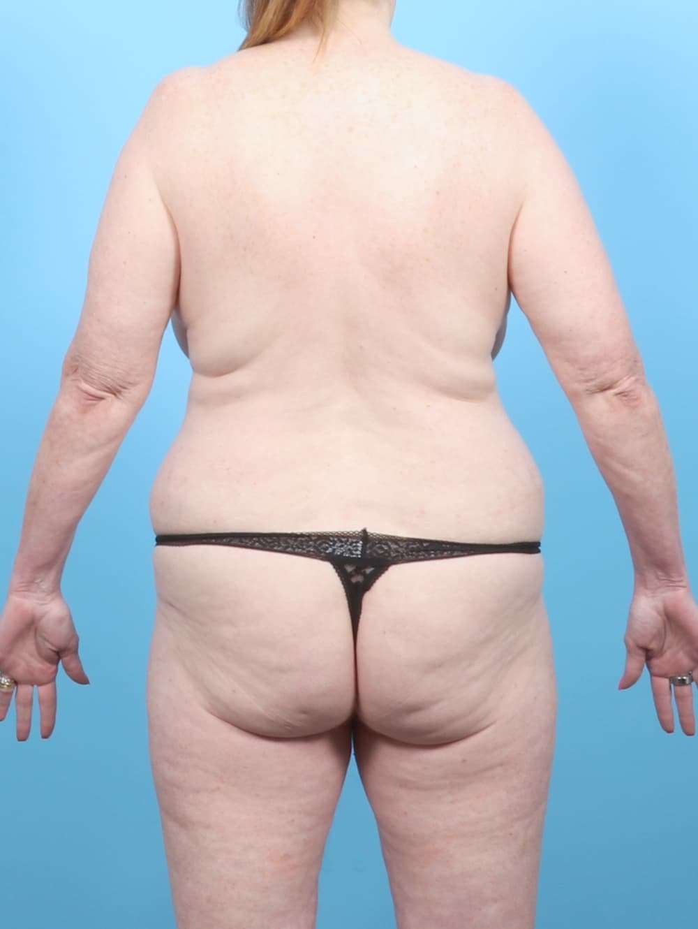 Liposuction case #7716 before, image 4