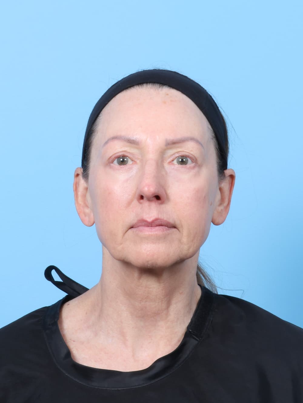 Eyelid Surgery case #8229 after