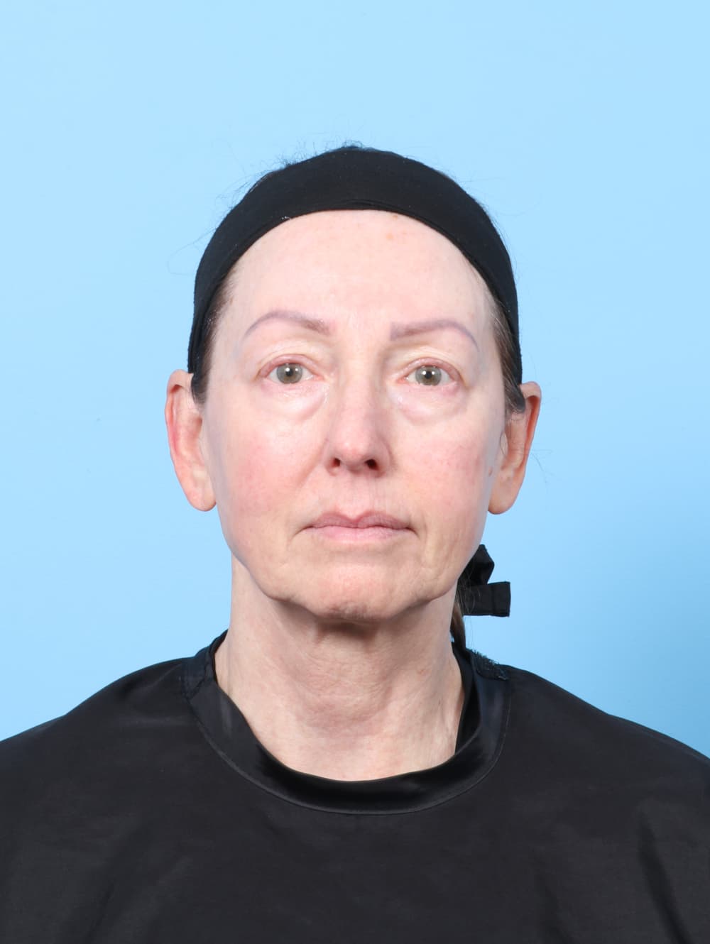 Eyelid Surgery case #8229 before