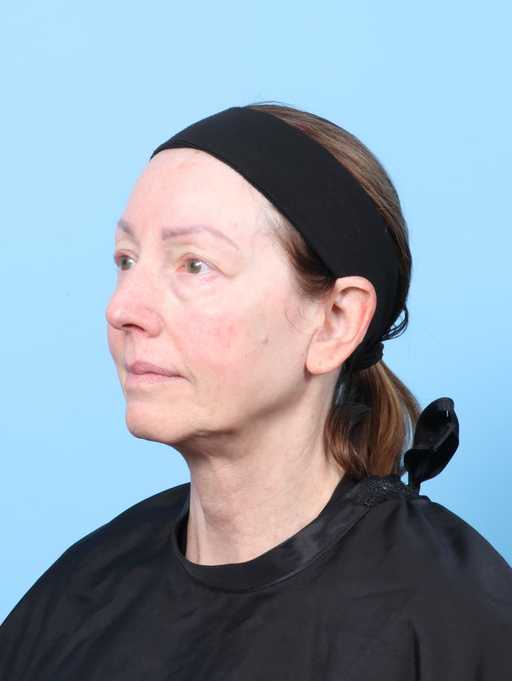 Eyelid Surgery case #8229 before, image 2
