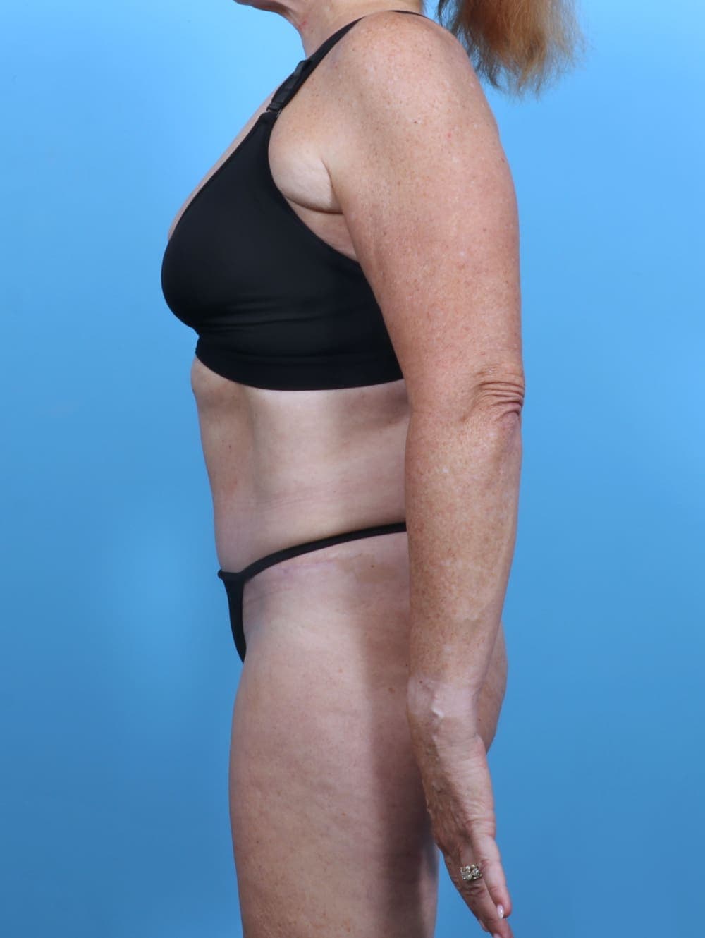 Tummy Tuck case #5474 after, image 3