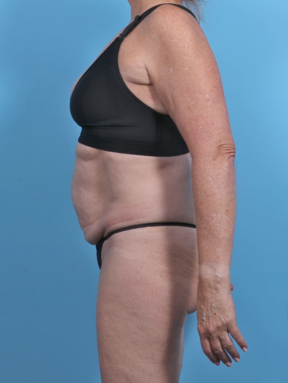Tummy Tuck case #5474 before, image 3