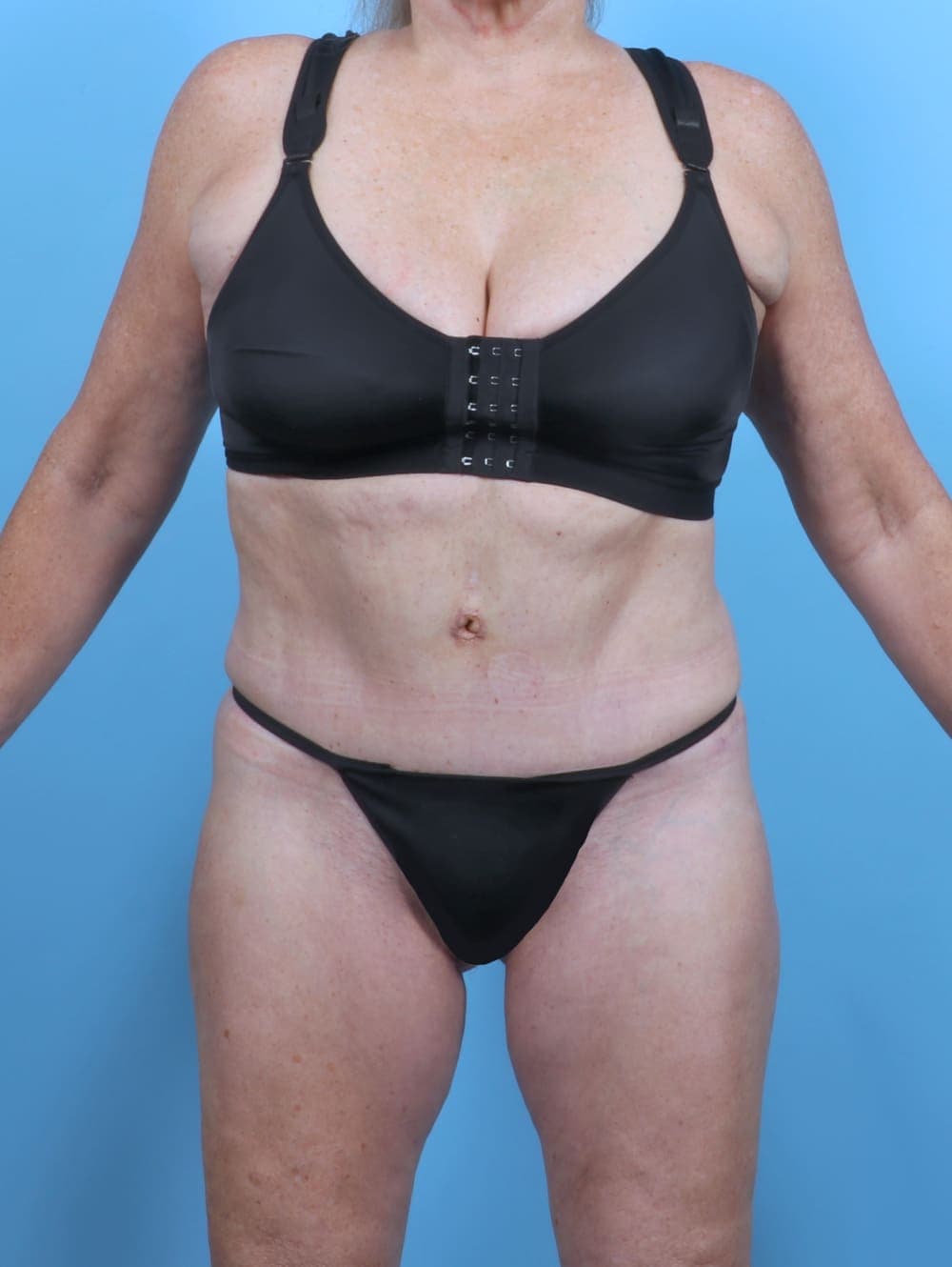 Tummy Tuck case #5474 after, image 1