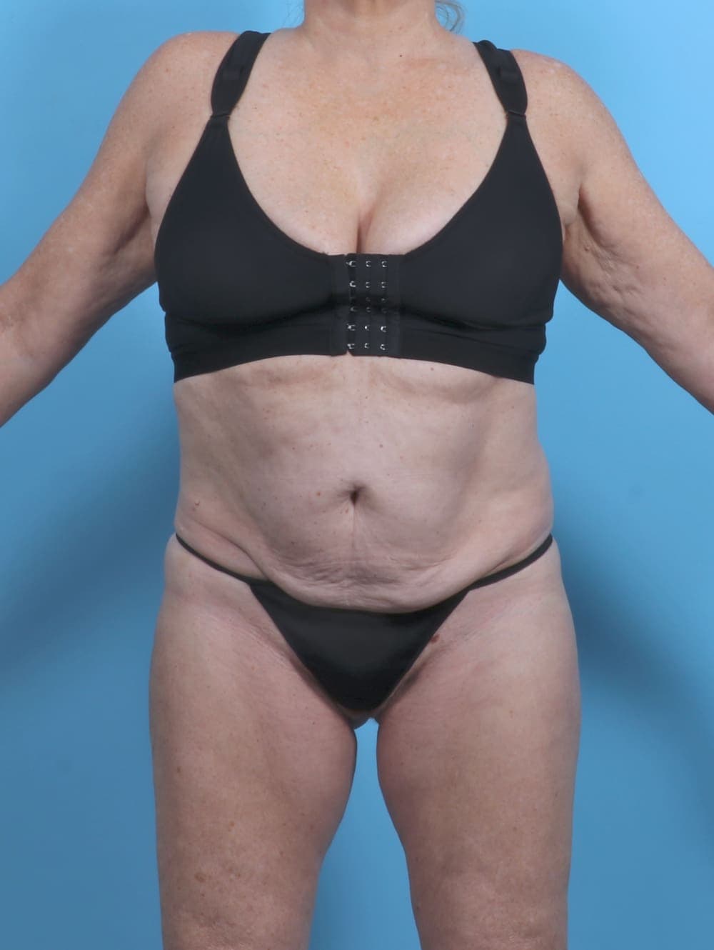 Tummy Tuck case #5474 before, image 1