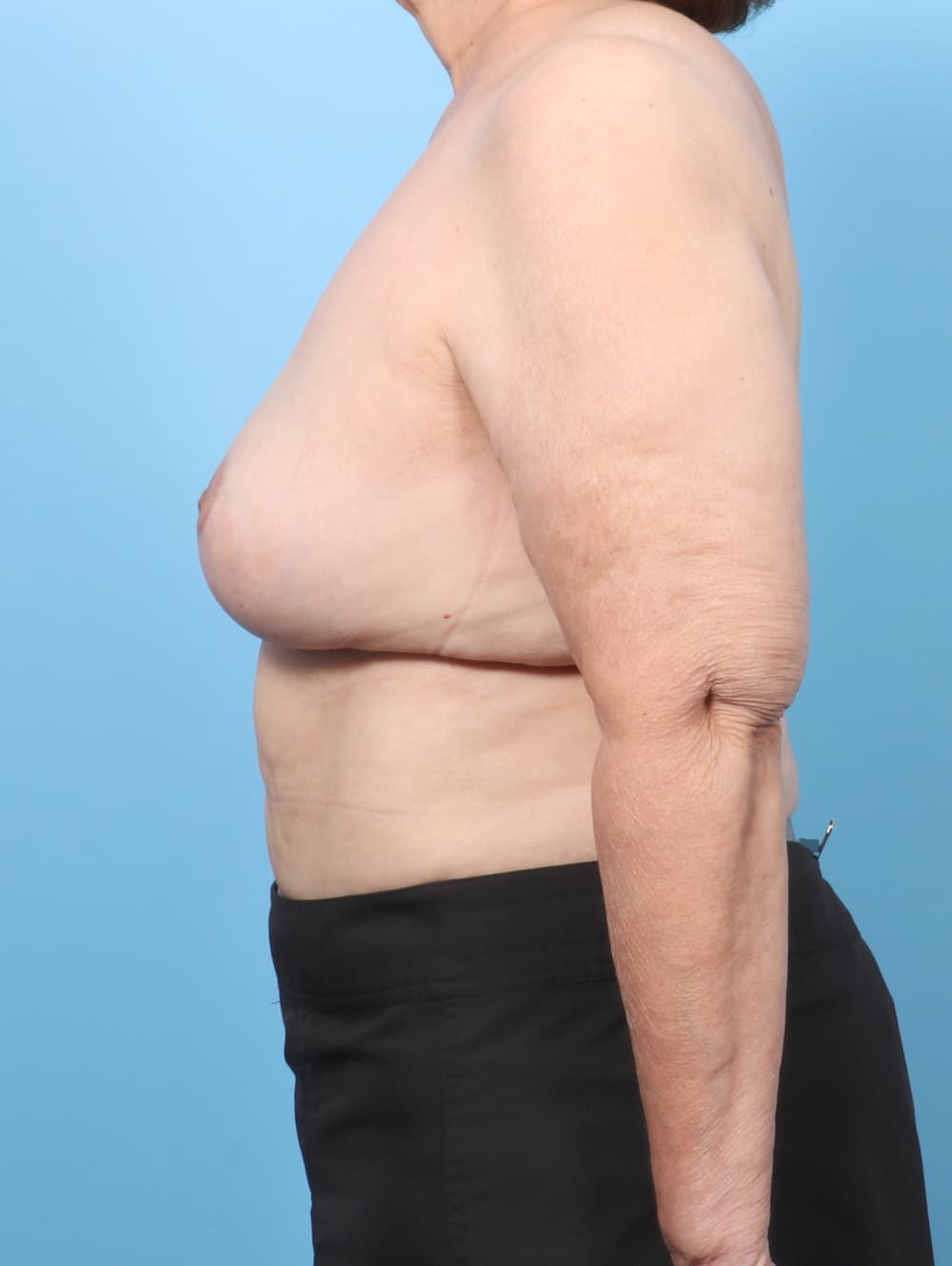 Breast Lift/Reduction case #8145 after, image 3