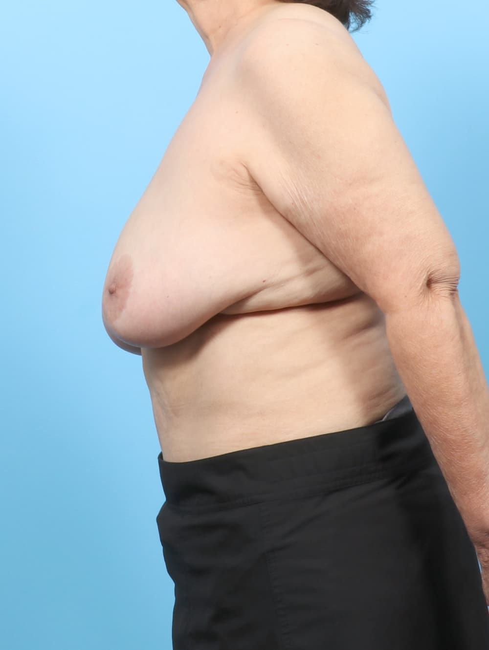 Breast Lift/Reduction case #8145 before, image 3