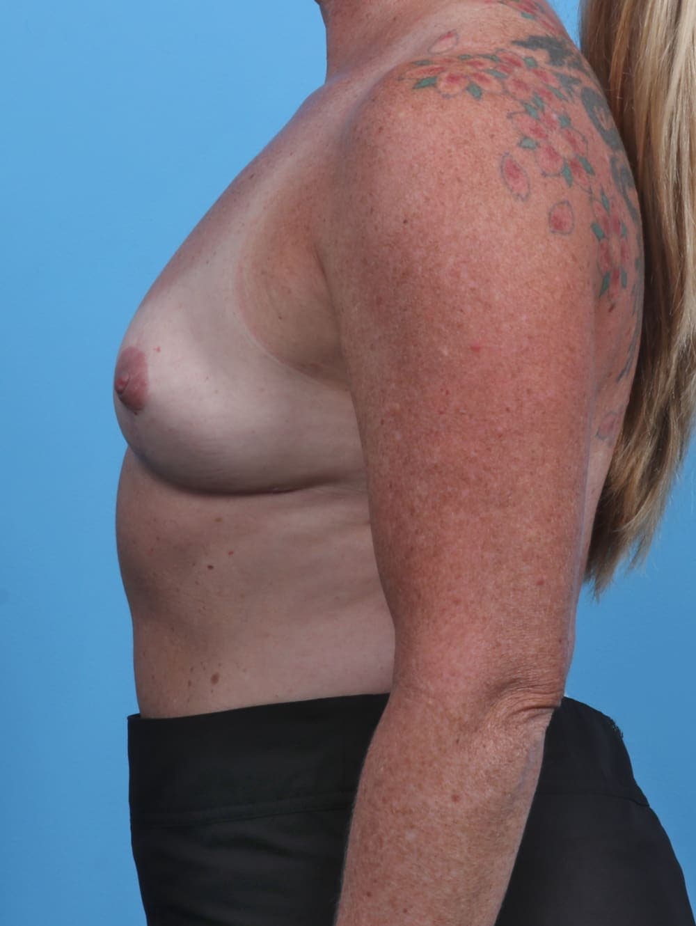 Breast Implant Removal with Lift case #3717 after, image 3