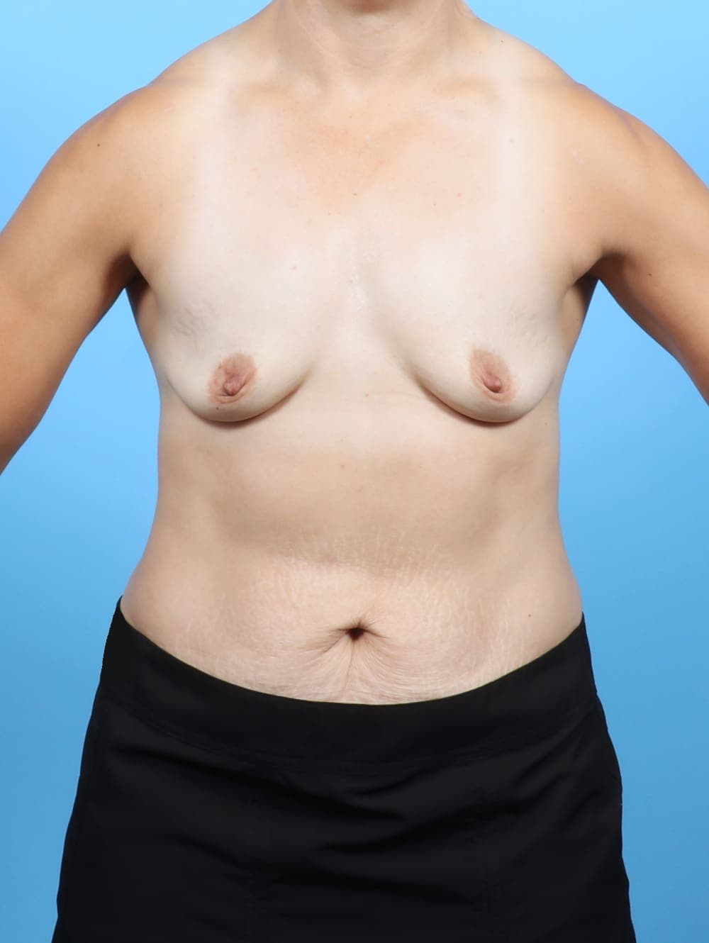 Breast Augmentation case #6743 before, image 1