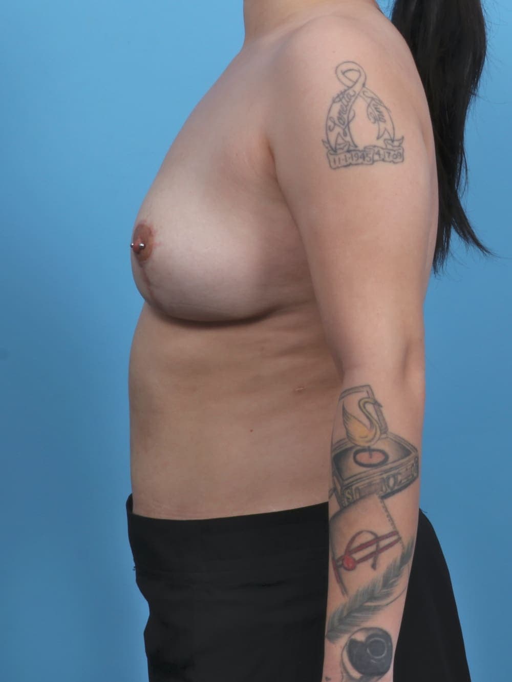 Breast Implant Removal with Lift case #4794 after, image 3