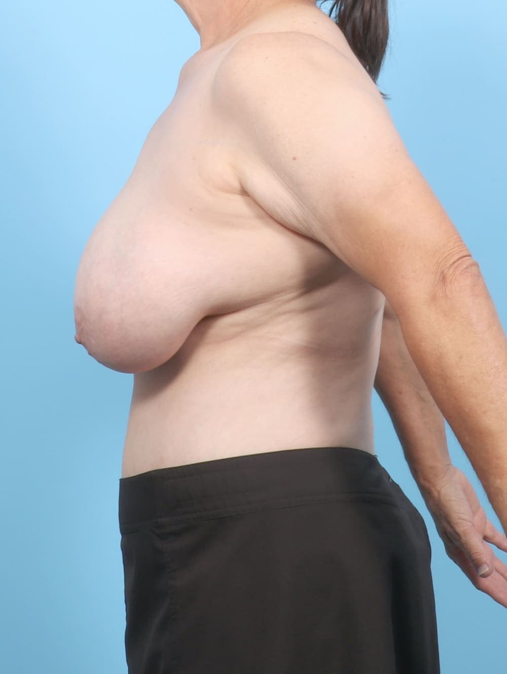 Breast Lift/Reduction case #6677 before, image 3