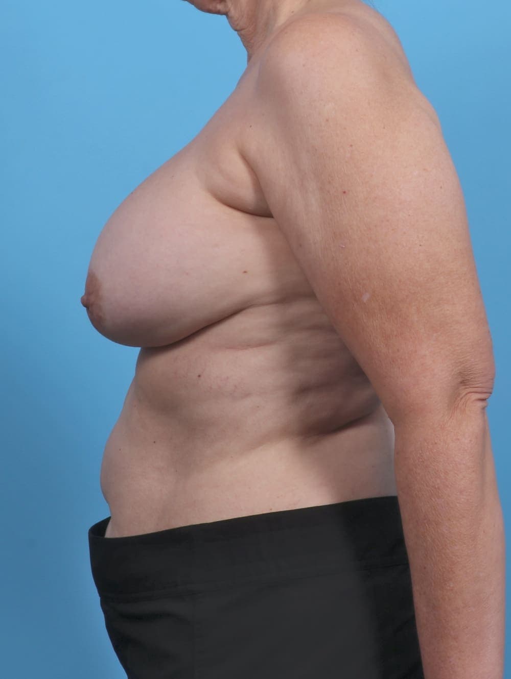 Breast Implant Revision case #4918 after, image 3