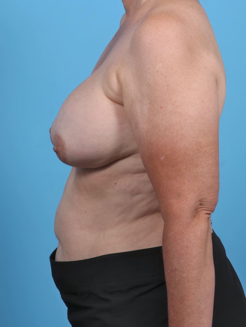 Breast Implant Revision case #4918 before, image 3